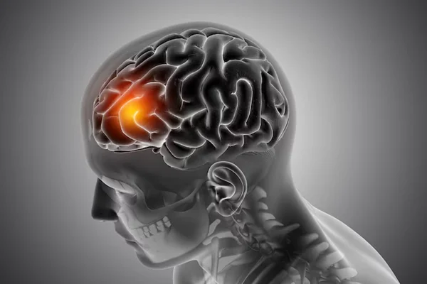Brain Tumour Treatment