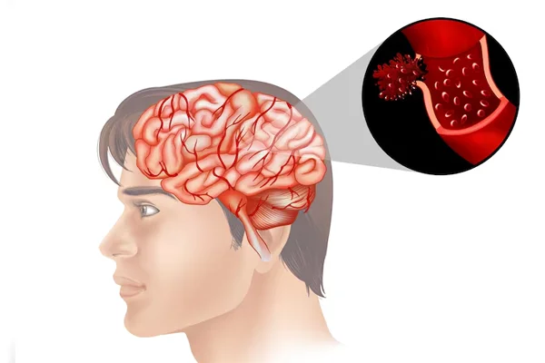 Brain Haemorrhage Treatment