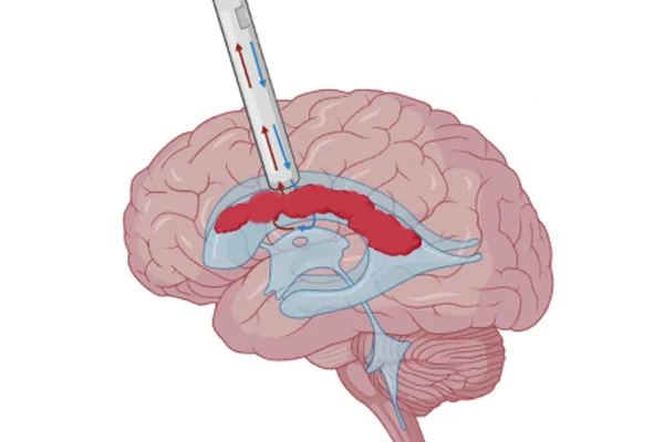 Neuroendoscopy